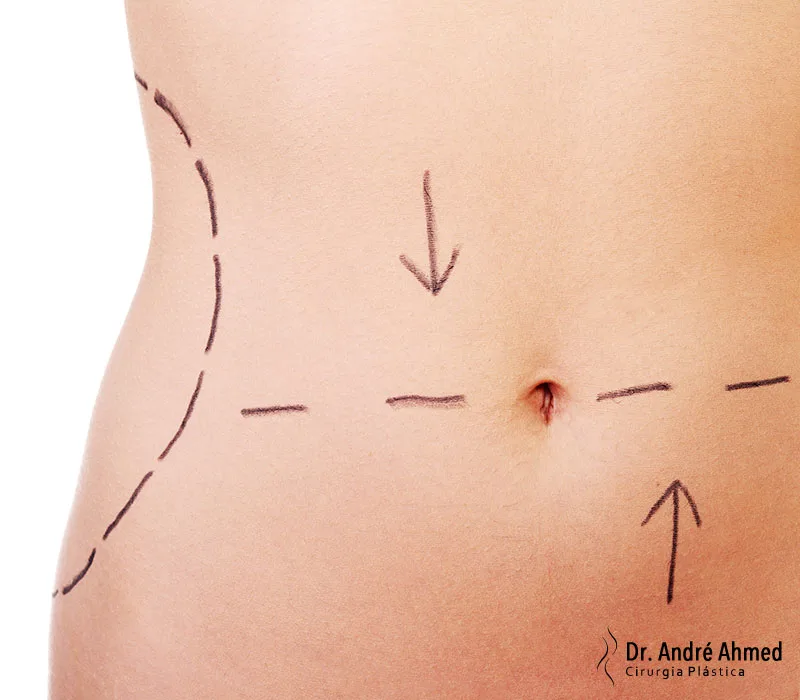 Lipoaspiração Segura Somente Com o Especialista