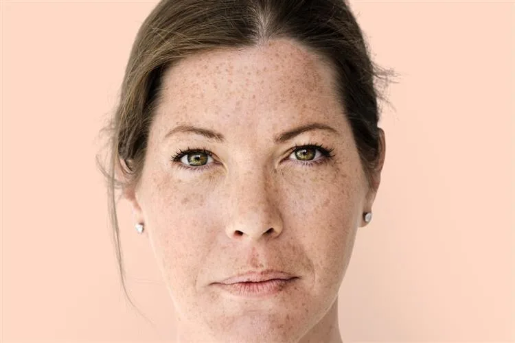 "O melasma não tem cura, mas tem controle", por Viviane Martins