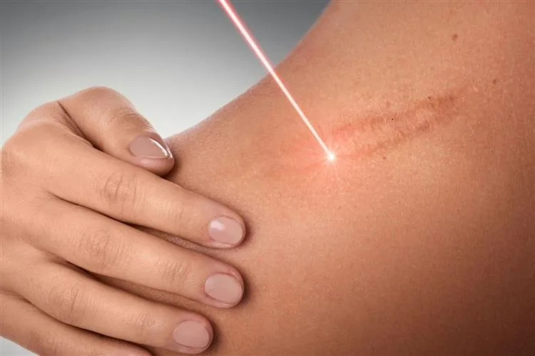 "Lasers são a saída para a correção de cicatrizes", por Viviane Martins
