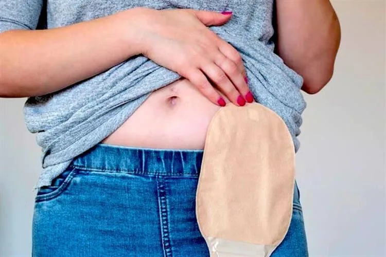Pacientes denunciam atraso na entrega de bolsas de colostomia