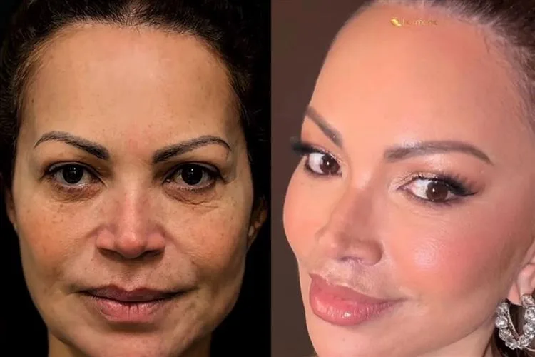 Solange Almeida impressiona ao revelar transformação após lifting facial
