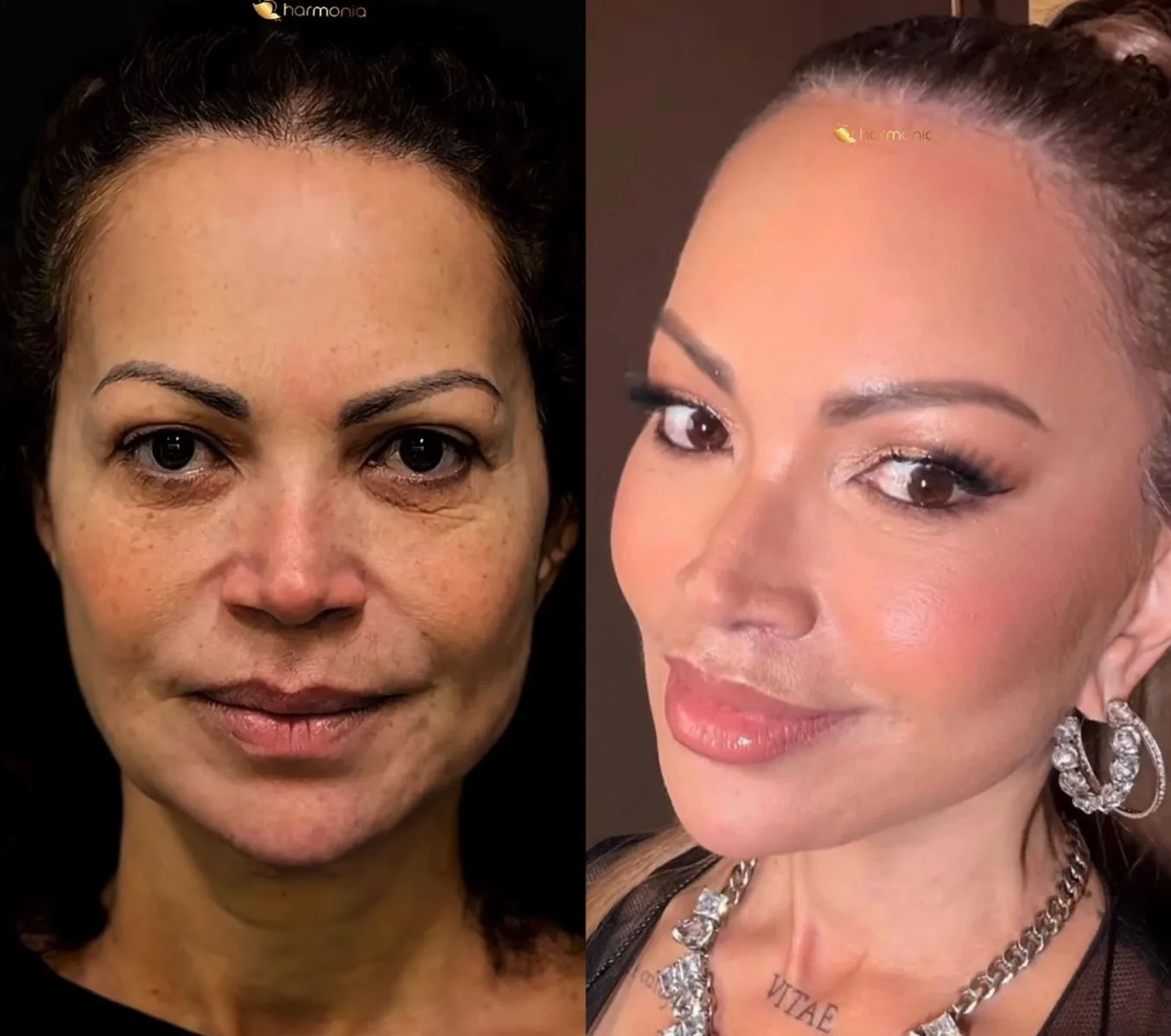Solange Almeida impressiona ao revelar transformação após lifting facial